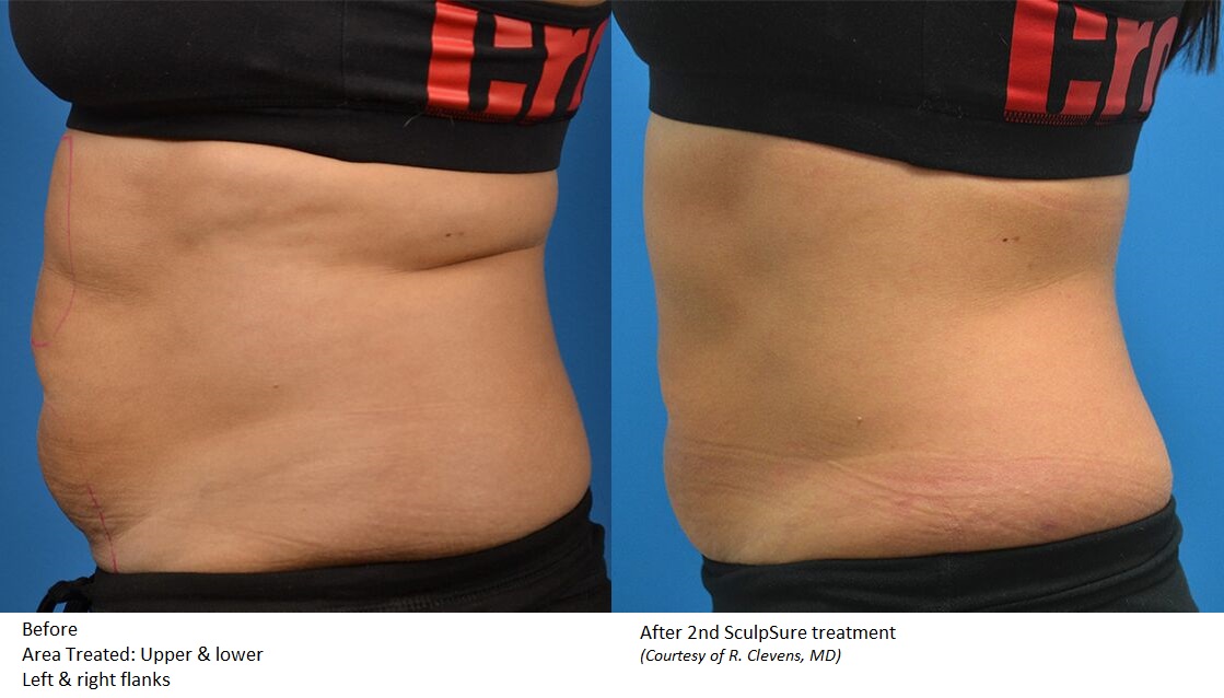 Sculpsure Before After1