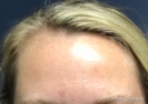 Botox (forehead)